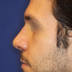 Revison Rhinoplasty Before & After Patient #13790