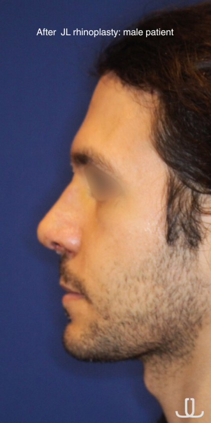Revison Rhinoplasty Before & After Patient #13790
