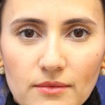Rhinoplasty Before & After Patient #13782