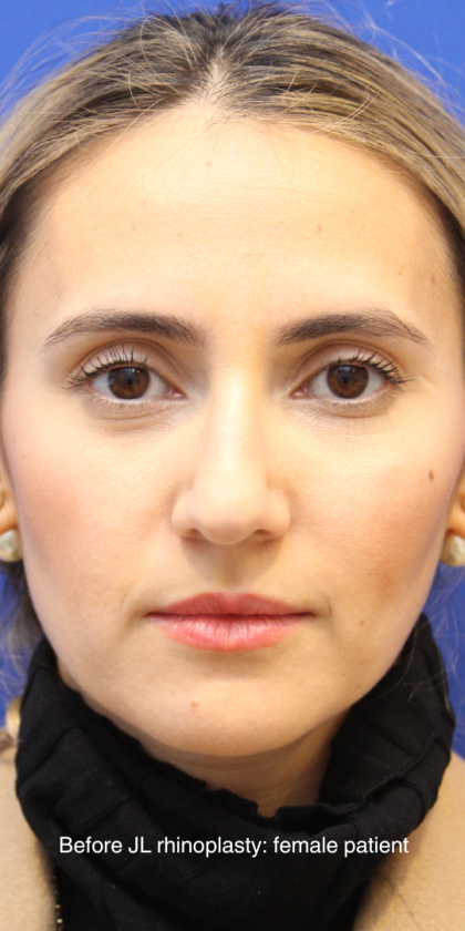 Rhinoplasty Before & After Patient #13782