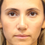 Rhinoplasty Before & After Patient #13782
