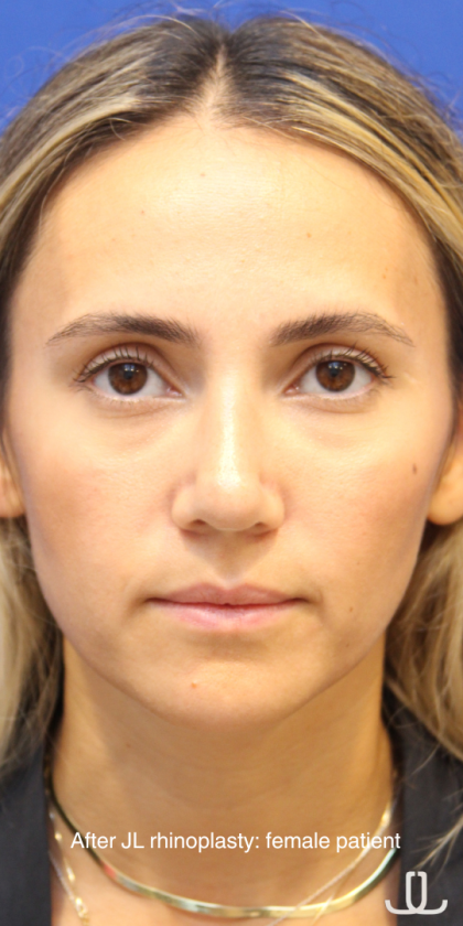 Rhinoplasty Before & After Patient #13782
