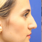 Rhinoplasty Before & After Patient #13782