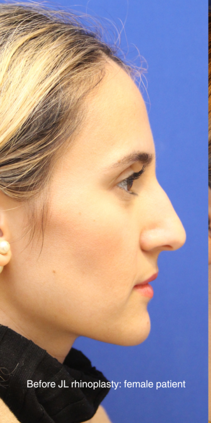 Rhinoplasty Before & After Patient #13782