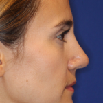 Rhinoplasty Before & After Patient #13782