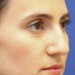 Rhinoplasty Before & After Patient #13782