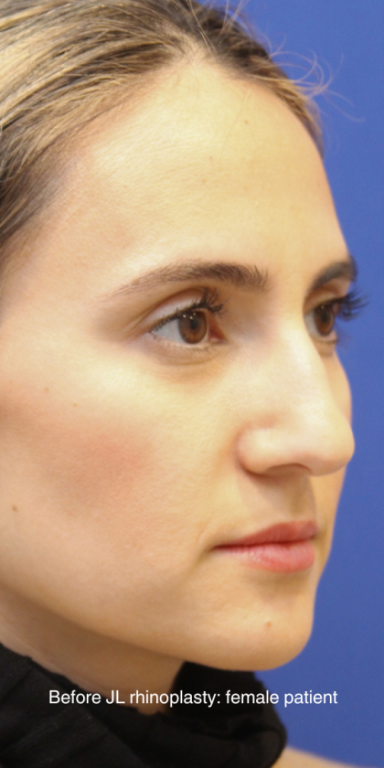 Rhinoplasty Before & After Patient #13782