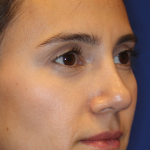 Rhinoplasty Before & After Patient #13782