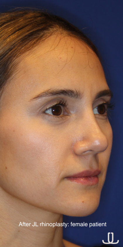 Rhinoplasty Before & After Patient #13782