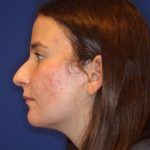 Septoplasty Before & After Patient #13552