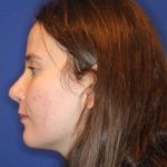 Septoplasty Before & After Patient #13552