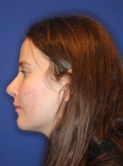 Septoplasty Before & After Patient #13552