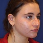 Septoplasty Before & After Patient #13554