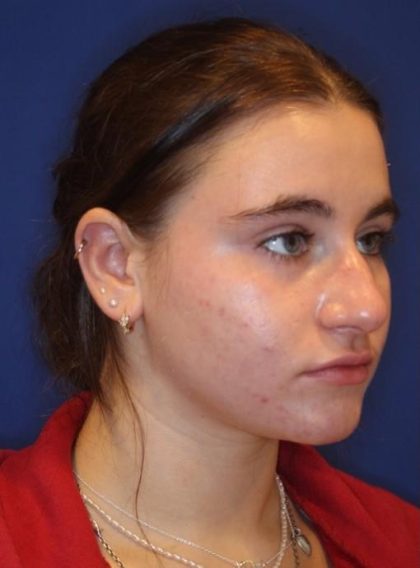 Septoplasty Before & After Patient #13554