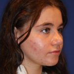 Septoplasty Before & After Patient #13554