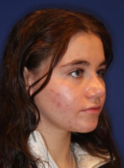 Septoplasty Before & After Patient #13554