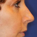 Septoplasty Before & After Patient #13556