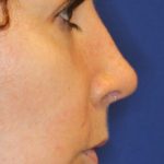 Septoplasty Before & After Patient #13556