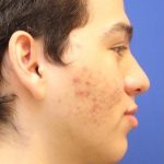 Septoplasty Before & After Patient #13558