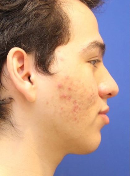 Septoplasty Before & After Patient #13558