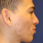Septoplasty Before & After Patient #13558