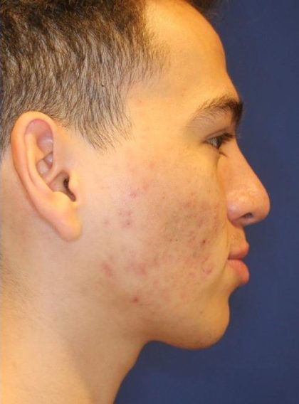 Septoplasty Before & After Patient #13558