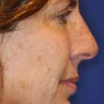 Septoplasty Before & After Patient #13560