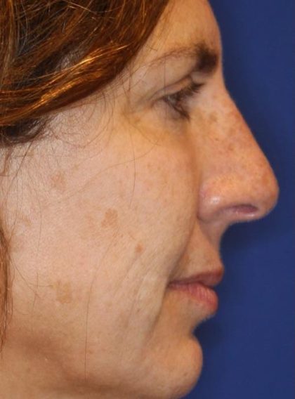 Septoplasty Before & After Patient #13560