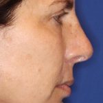 Septoplasty Before & After Patient #13560
