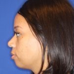 Septoplasty Before & After Patient #13561