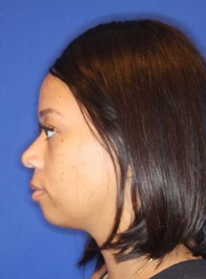 Septoplasty Before & After Patient #13561