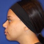 Septoplasty Before & After Patient #13561