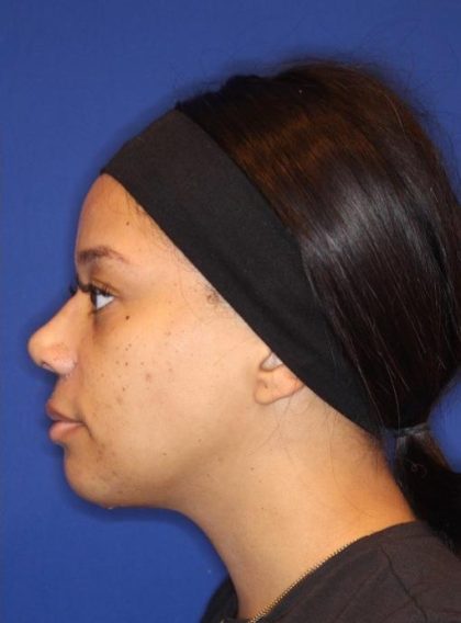 Septoplasty Before & After Patient #13561