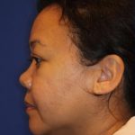Septoplasty Before & After Patient #13563