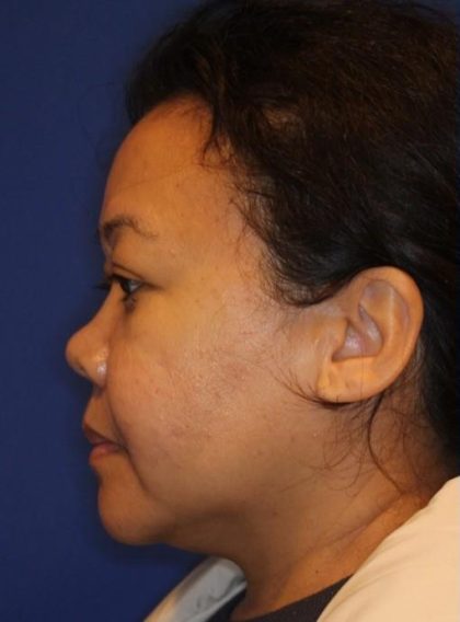 Septoplasty Before & After Patient #13563