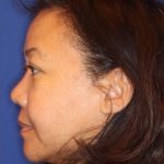Septoplasty Before & After Patient #13563