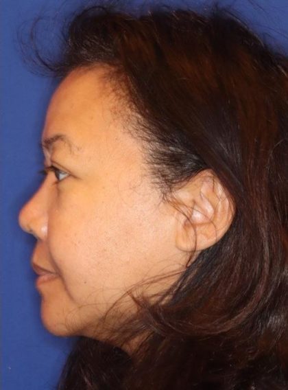 Septoplasty Before & After Patient #13563