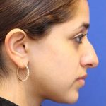 Septoplasty Before & After Patient #13565