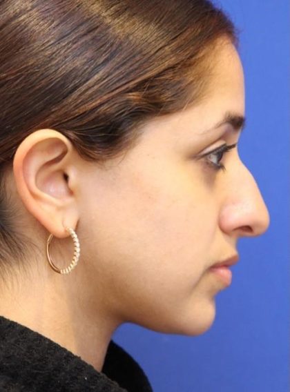 Septoplasty Before & After Patient #13565