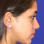 Septoplasty Before & After Patient #13565