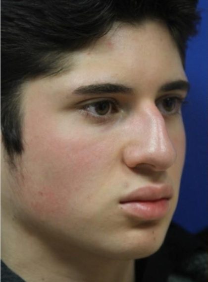 Septoplasty Before & After Patient #13596
