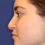Septoplasty Before & After Patient #13535