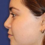 Septoplasty Before & After Patient #13535