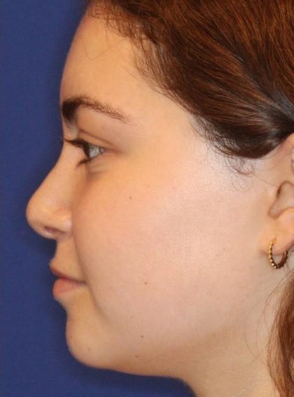 Septoplasty Before & After Patient #13535