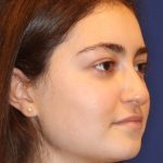 Septoplasty Before & After Patient #13535