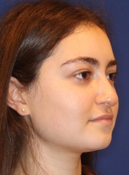 Septoplasty Before & After Patient #13535