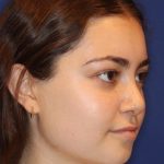 Septoplasty Before & After Patient #13535