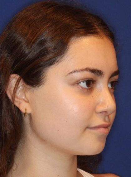 Septoplasty Before & After Patient #13535