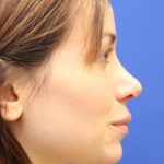 Septoplasty Before & After Patient #13539