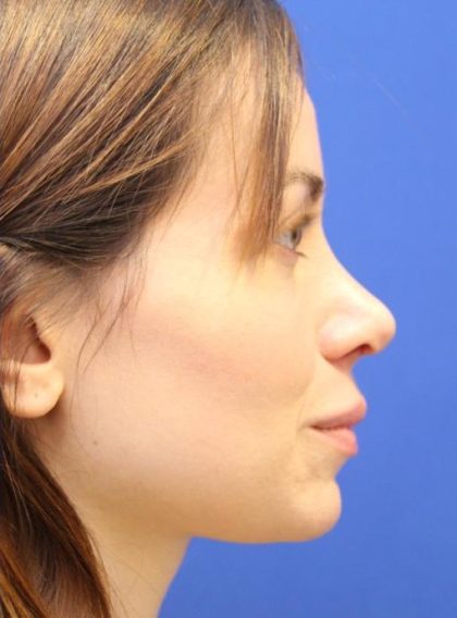 Septoplasty Before & After Patient #13539